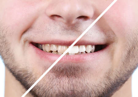 Smiling man isolated on white: before and after conceptの写真素材