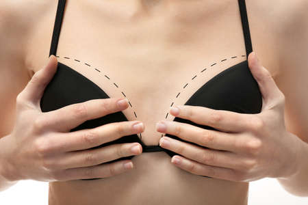 Young female body with marks for plastic operation, closeupの写真素材