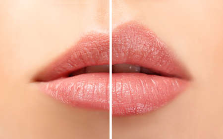 Female lips before and after augmentation procedure. Beauty conceptの写真素材