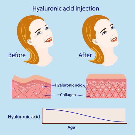 hyaluronic acid injection, before and affect , vector illustration, diagramのイラスト素材