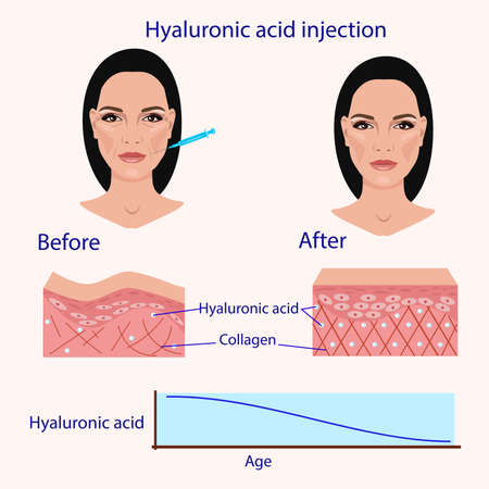 Hyaluronic acid injection, before and affect  vector illustration diagramのイラスト素材