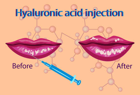 Lips procedure illustration.のイラスト素材