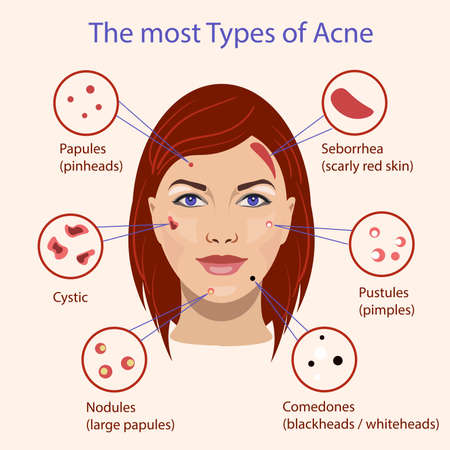 Different type of acne. Vector Illustration with skin problems.のイラスト素材
