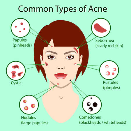 Different type of acne. Vector Illustration with skin problems. woman face isolatedのイラスト素材