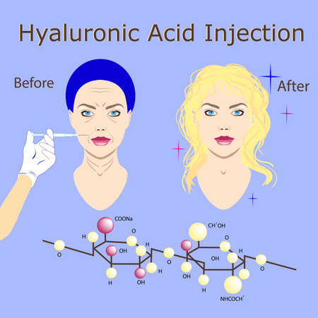 hyaluronic acid injection, before and affect , vector illustrationのイラスト素材