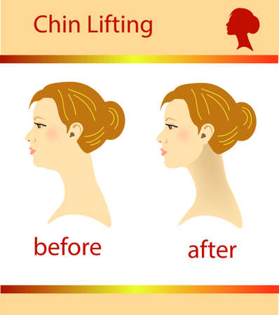 Illustration of a woman with a double chin and a normal chin, vector illustrationのイラスト素材