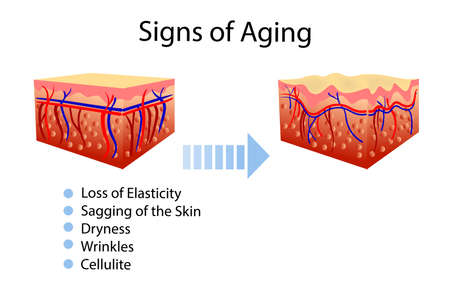 Vector diagram with signs of aging, two types of skin, for cosmetological and healthcare illustrationsのイラスト素材