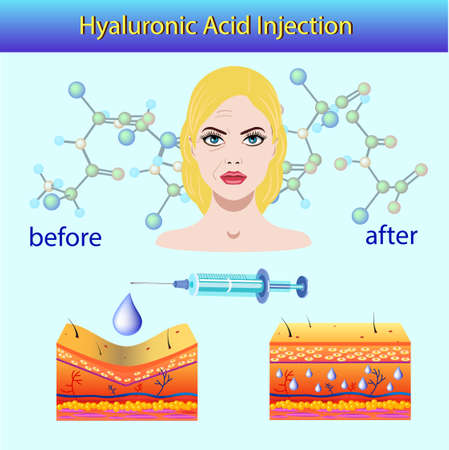 Vector illustration with cosmetic filler or Dermal fillers on light backgroundのイラスト素材