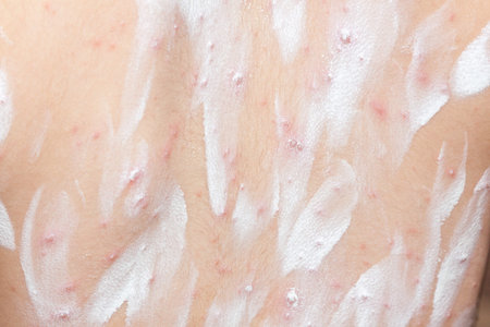 Detail baby with chicken pox rash