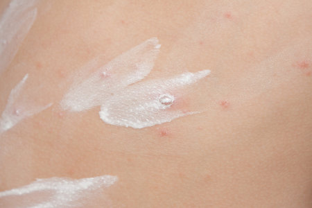 Detail baby with chicken pox rash