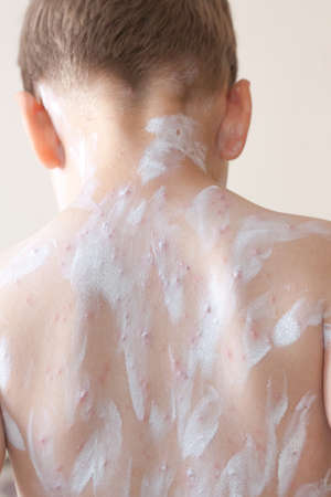 Detail baby with chicken pox rashの写真素材