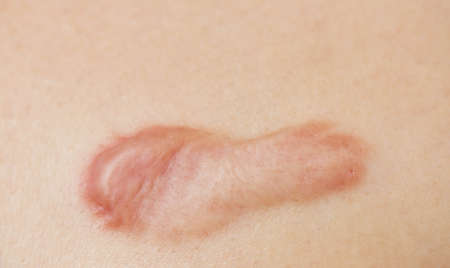 The scars on the breast skinの写真素材