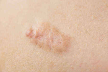 The scars on the breast skinの写真素材