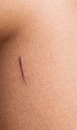 The scars on the skinの写真素材