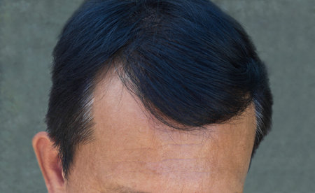 Human alopecia or hair loss problem and grizzly , shot from front view