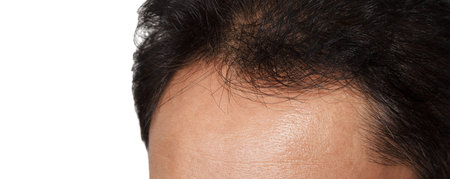 hair loss
