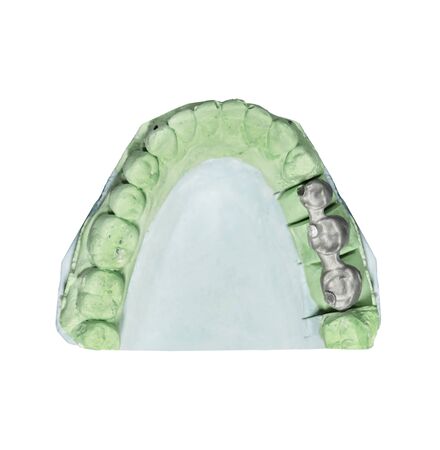 Dental tooth implant plaster pattern with metal bridge isolated on whiteの写真素材