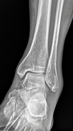 X-ray image of the ankle showing a fracture to lateral malleolus without dislocation, highlighting the importance of medical imaging in diagnosing and treating such injuries.の写真素材