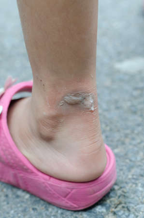 scald burn blister on ankleの写真素材