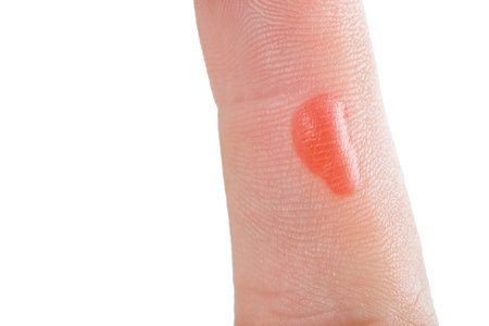 On hand finger there is red blister, the callus. Workers trauma after hard work inflamed part of the...