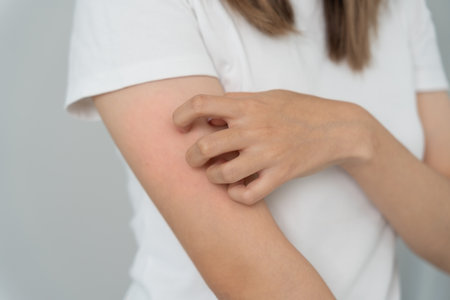 skin problem and beauty. Young woman scratch body has itchy skin from skin allergic, steroid allergy, sensitive skin, red from sunburn, chemical allergy, rash, insect bites, Seborrheic Dermatitis.の写真素材