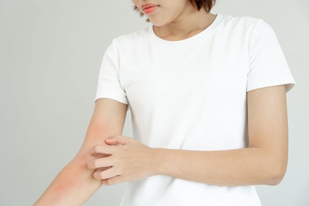 skin problem and beauty. Young woman scratch body has itchy skin from skin allergic, steroid...