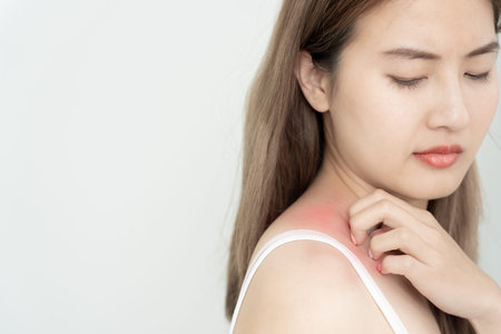 skin problem and beauty. Young woman scratch body has itchy skin from skin allergic, steroid...