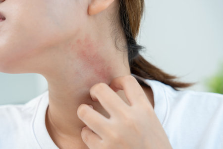 skin problem and beauty. Young woman scratch body has itchy skin from skin allergic, steroid allergy, sensitive skin, red from sunburn, chemical allergy, rashの写真素材