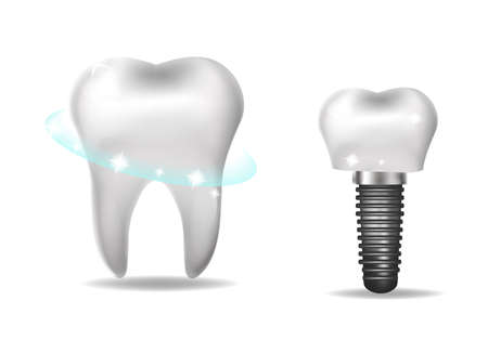Dental implants, prosthetics 3D realistic style. Dentistry, healthy teeth concept. Vector illustration.のイラスト素材