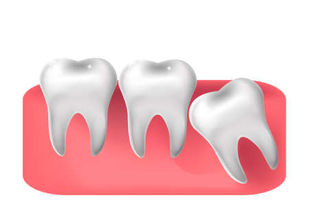 Wisdom tooth cut through, 3d realistic style. Dentistry, wisdom teeth extraction concept. Vector illustration.のイラスト素材