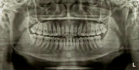 Dental Radiograph X-Rayの写真素材