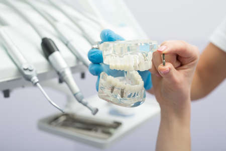 Dental implant teeth model in the hand in a blue latex glove and a single implant in the other hand. On the blurry background of dental equipment. Horizontal.の写真素材