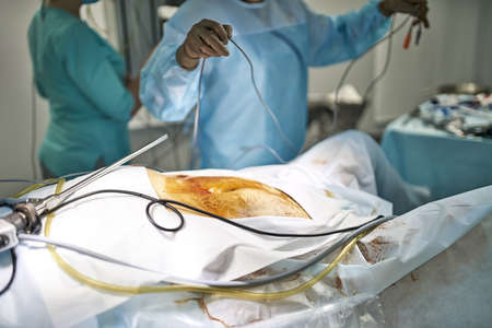 Laparoscopy operation processの写真素材