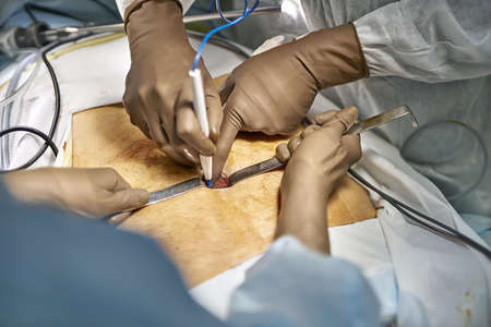 Laparoscopy operation processの写真素材