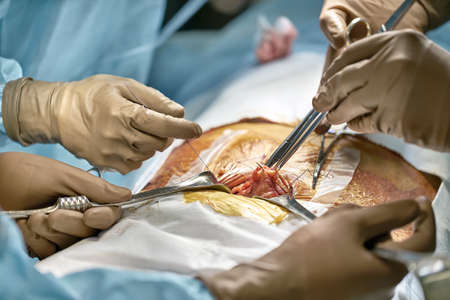 Abdominal operation processの写真素材