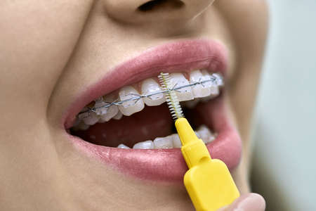 Woman is showing her teeth with braces in a dental clinic. Dentist is cleaning her bracket system...
