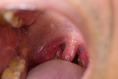 tonsil throat,Oral tonsilの写真素材