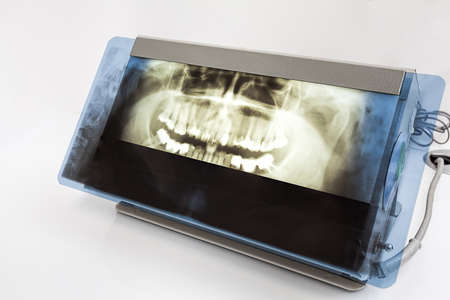 X-ray of a jaw on a white isolated backgroundの写真素材