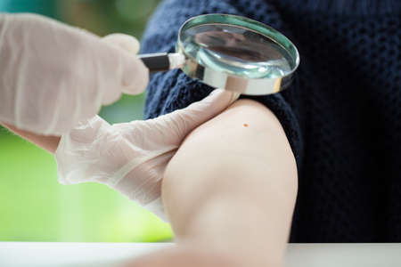 Dermatologist using magnifying glass to examine a moleの写真素材