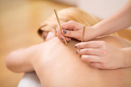 Therapist doing acupuncture to young pretty womanの写真素材