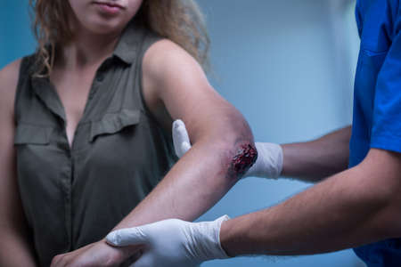 Closeup of young woman with injured elbowの写真素材