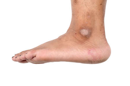 Close up of cracked heels and ankles on white background