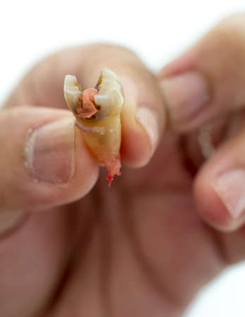 decay molar tooth in a human hand on a white backgroundの写真素材