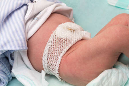 Newborn with plastic navel clamps and bandage