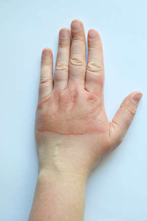 Horrible second degree burns on female hand on white background.