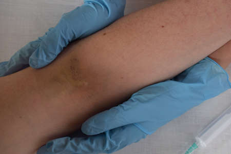 Dark big bruise on the arm as result of doctor mistake taking the blood with syringe from vein.の写真素材