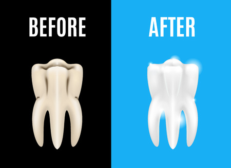 Teeth whitening before and after card poster.のイラスト素材