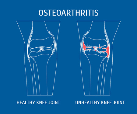 Thin Line Osteoarthritis Healthy and Unhealthy Knee.のイラスト素材