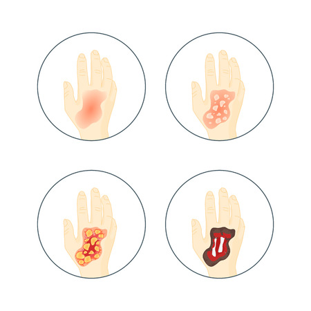 Human Skin Burns Icon Set.のイラスト素材
