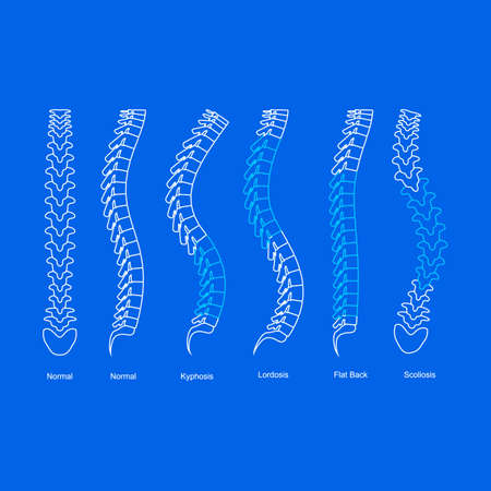 Osteoporosis Bone Types Infographics Concept Card Poster Contour Linear Style. Vectorのイラスト素材